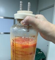 通辽水动力吸脂手术要做多久？